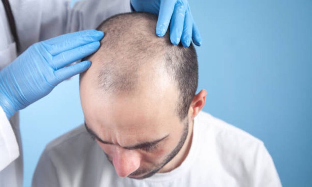 best hair transplant in Arizona